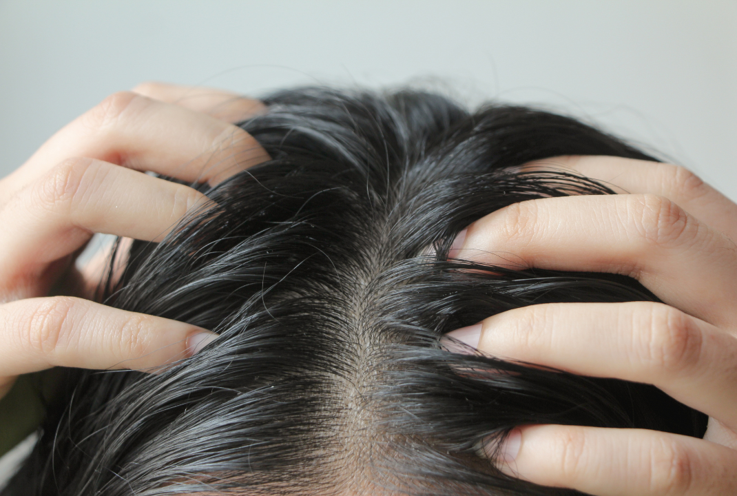 How to Tackle Scalp Dryness In Winter: Causes, Hair Masks, and Expert Tips